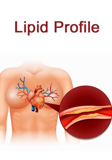 Lipid Profile